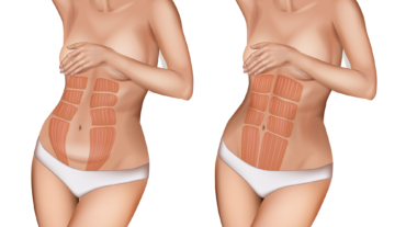 Diástasis abdominal